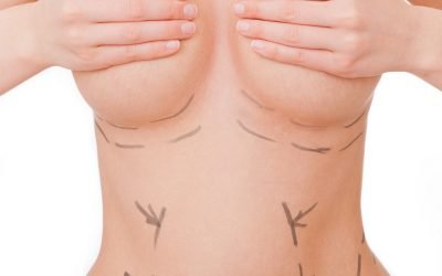 Ist eine Brustvergrößerung ohne Implantat möglich?