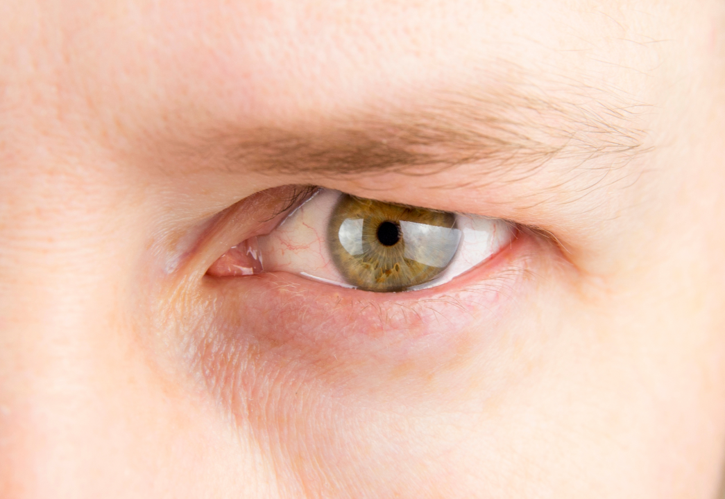 schlupflid 2 Mann mit ausgeprägtem Schlupflid.