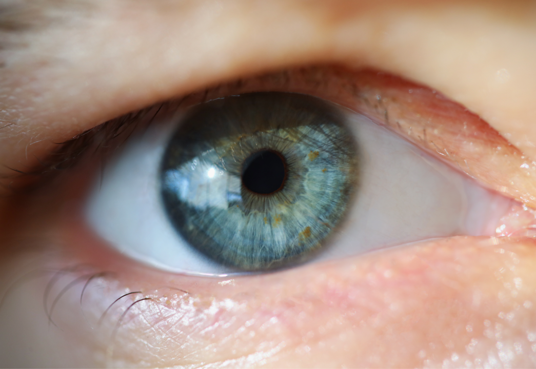 schlupflider Mann mit Schlupflid.